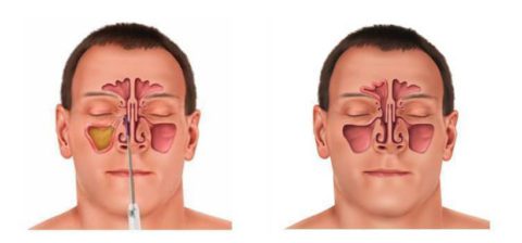 Sinus and breathing relief diagram front view