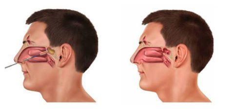 Sinus and breathing relief diagram profile view